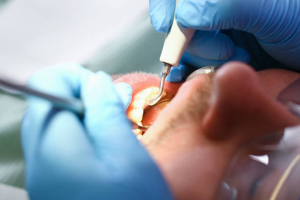Best Emergency Root Canal Treatment in Meridian, MS